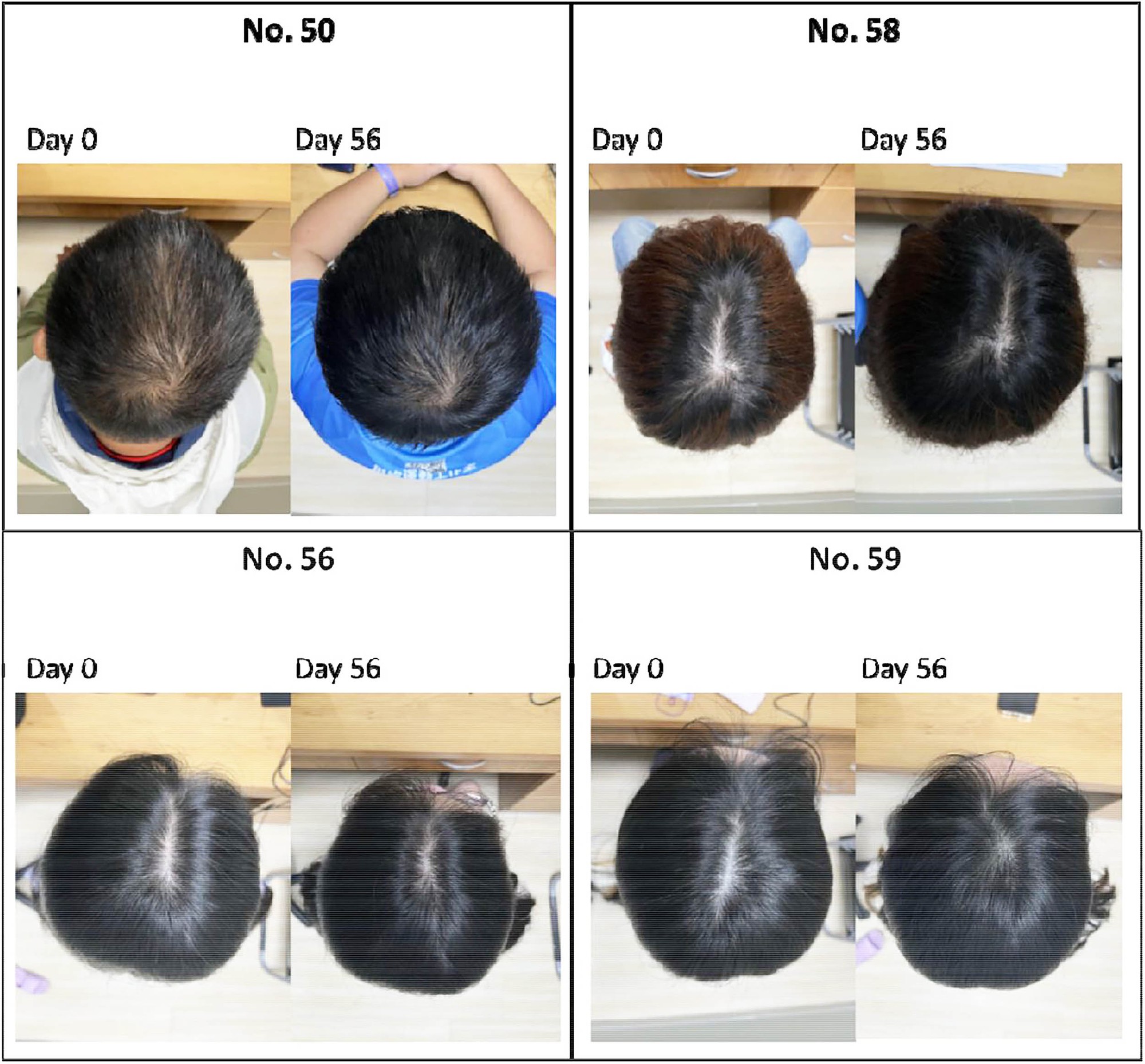 Bệnh hói đầu sắp ”tuyệt chủng” đến nơi: Huyết thanh từ thực vật giúp tóc dày lên 25% chỉ trong 56 ngày - Ảnh 1.